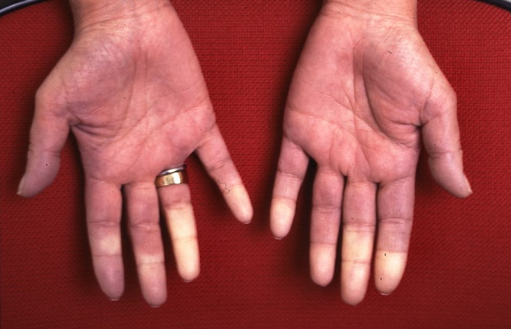 Fenomeno di Raynaud